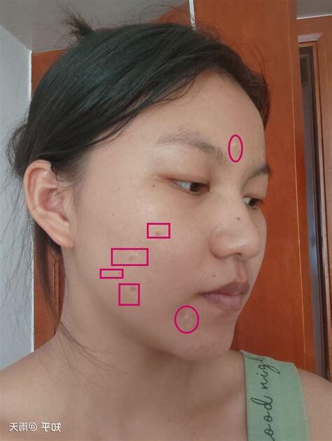 右眼角 痣